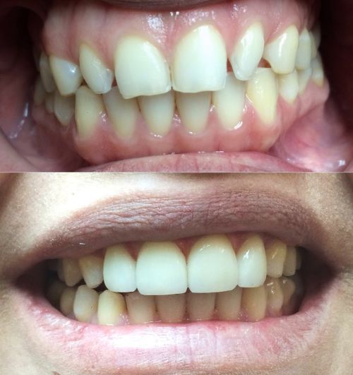 Veneers Encinitas, California Dr. John Maroon, DDS